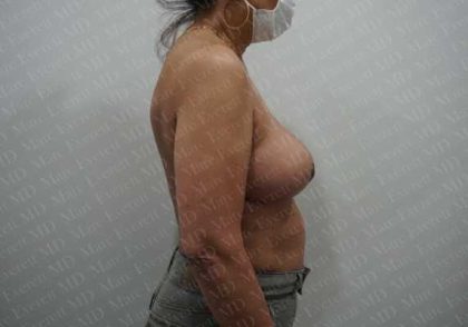 Breast Reduction Before & After Patient #1400