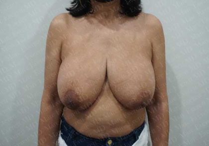 Breast Reduction Before & After Patient #1400