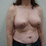 Breast Reduction Before & After Patient #1399