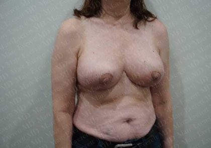 Breast Reduction Before & After Patient #1399