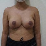 Breast Reduction Before & After Patient #1375