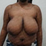 Breast Reduction Before & After Patient #1371