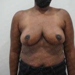 Breast Reduction Before & After Patient #1371
