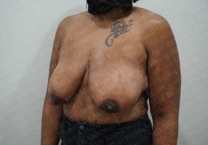 Breast Reduction Before & After Patient #1340