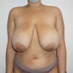 Breast Reduction Before & After Patient #1339