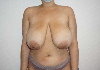 Breast Reduction Before & After Patient #1339