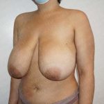 Breast Reduction Before & After Patient #1339