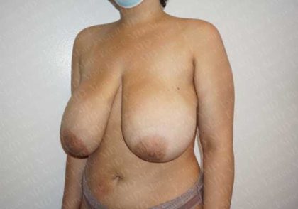 Breast Reduction Before & After Patient #1339