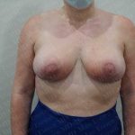 Breast Reduction Before & After Patient #1337