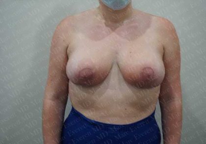 Breast Reduction Before & After Patient #1337