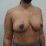 Breast Reduction Before & After Patient #1336