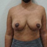 Breast Reduction Before & After Patient #1336