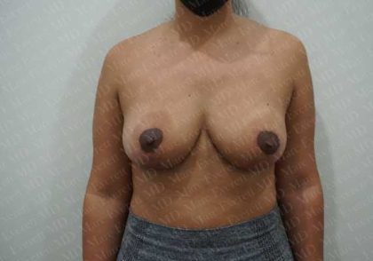 Breast Reduction Before & After Patient #1336