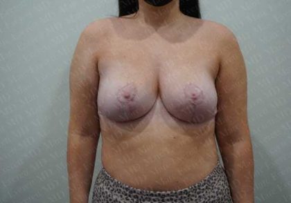 Breast Reduction Before & After Patient #1306