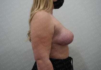 Breast Reduction Before & After Patient #1303