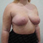 Breast Reduction Before & After Patient #1303