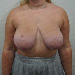 Breast Reduction Before & After Patient #1303