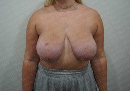 Breast Reduction Before & After Patient #1303