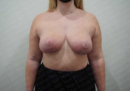 Breast Reduction Before & After Patient #1303