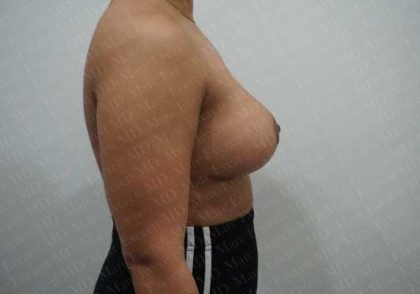 Breast Reduction Before & After Patient #1283