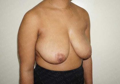 Breast Reduction Before & After Patient #1283