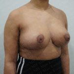 Breast Reduction Before & After Patient #1283