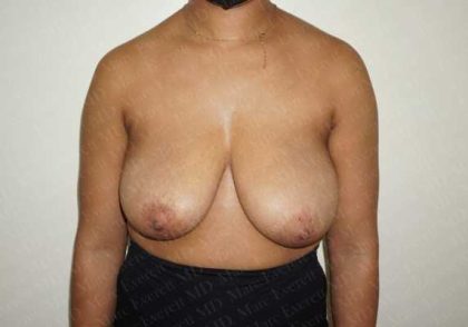 Breast Reduction Before & After Patient #1283