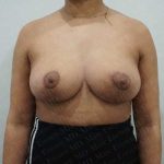 Breast Reduction Before & After Patient #1283