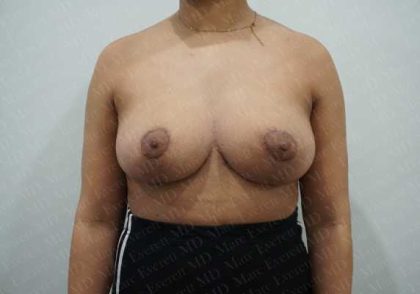 Breast Reduction Before & After Patient #1283