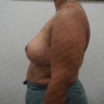 Breast Reduction Before & After Patient #1281