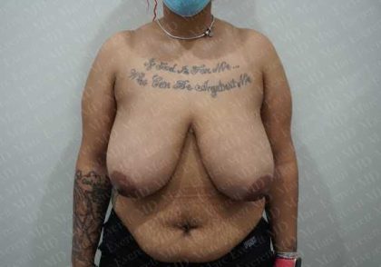 Breast Reduction Before & After Patient #1281