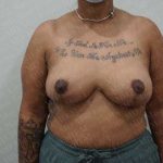 Breast Reduction Before & After Patient #1281