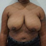 Breast Reduction Before & After Patient #1279