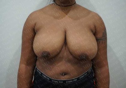 Breast Reduction Before & After Patient #1279