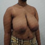 Breast Reduction Before & After Patient #1246