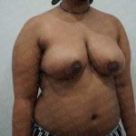 Breast Reduction Before & After Patient #1246