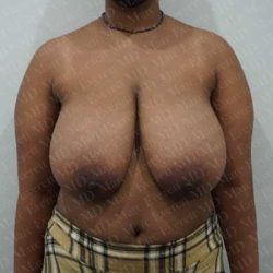 Breast Reduction Before & After Patient #1246