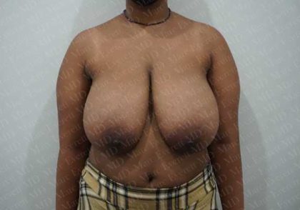 Breast Reduction Before & After Patient #1246