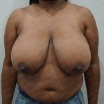 Breast Reduction Before & After Patient #1244