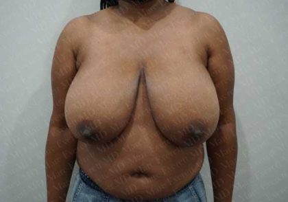 Breast Reduction Before & After Patient #1244