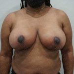 Breast Reduction Before & After Patient #1244