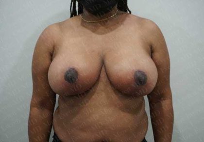 Breast Reduction Before & After Patient #1244