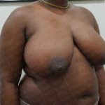 Breast Reduction Before & After Patient #1243