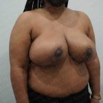 Breast Reduction Before & After Patient #1242