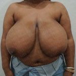 Breast Reduction Before & After Patient #1242