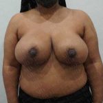 Breast Reduction Before & After Patient #1242