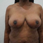 Breast Reduction Before & After Patient #1212