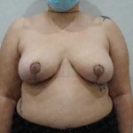 Breast Reduction Before & After Patient #1210