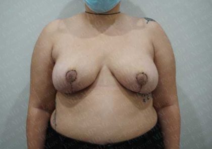 Breast Reduction Before & After Patient #1210