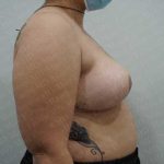 Breast Reduction Before & After Patient #1210